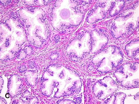 Benign Prostatic Hyperplasia