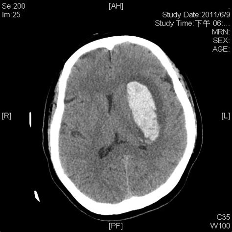 Putaminal Hemorrhage; Brain Hemorrhage, Putaminal; Hemorrhage, Putamen