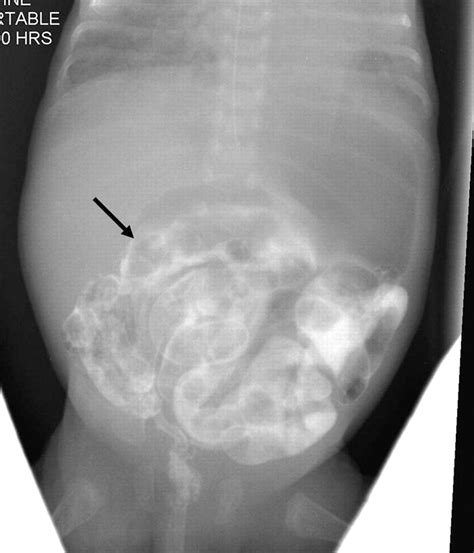 Meconium obstruction of prematurity | ADC Fetal & Neonatal Edition