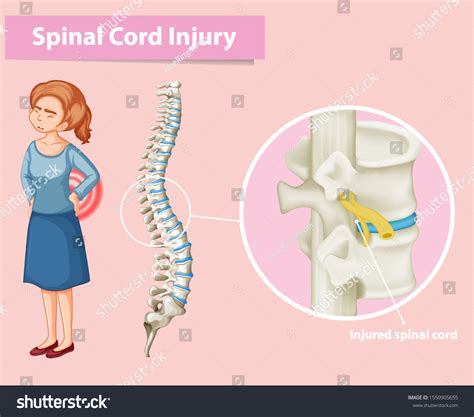 Diagram Showing Spinal Cord Injury Human Stock Vector (Royalty Free ...