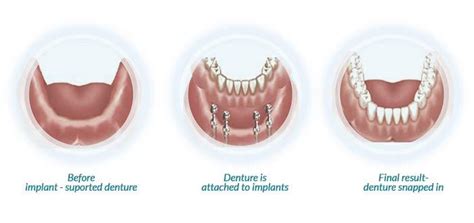 Snap-On Dentures | 1-877-886-1762 | FDG | OneSolution Dental Implants