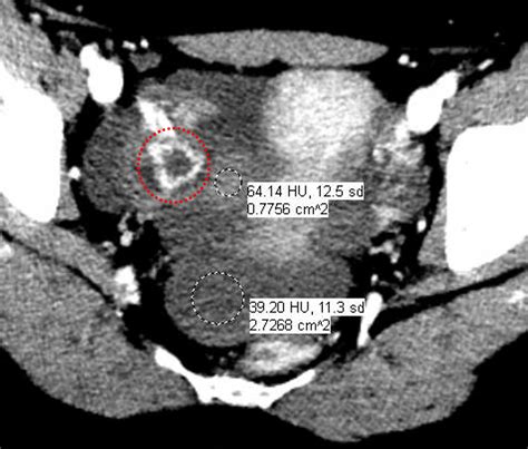 Hemorrhagic Ovarian Cyst Mri