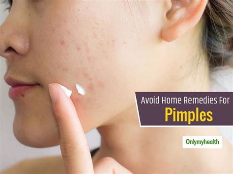 Avoid Any Random Home Remedy For Acne and Pimples, Seek These ...