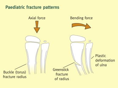 Greenstick Fracture