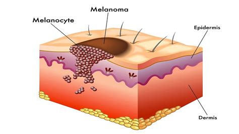 What Is Melanoma? | Skin Cancer - YouTube