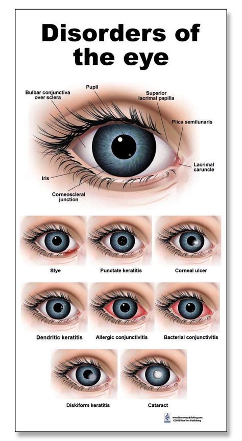 Eye Diseases Chart