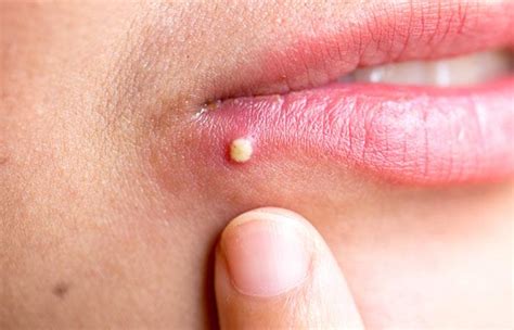 Cold Sore Vs. Pimple: Causes, Symptoms, And Treatment