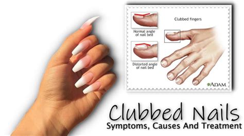 Clubbed Nails : Symptoms, Causes And Treatment - Fancy Nail Art