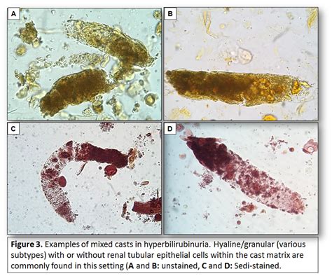 Urine Sediment of the Month: Mixed, Acellular Casts - Renal Fellow Network