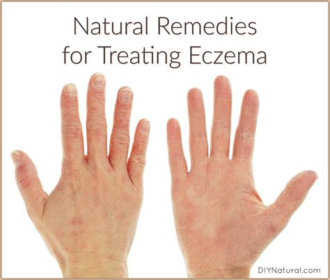 Natural Remedies for Eczema: Both Internal and External Tips