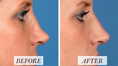 What Is Nonsurgical Rhinoplasty? Risks and Results of Nose Fillers | Allure