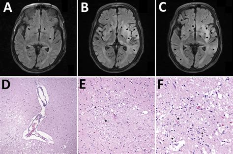 Figure 2 - Four Human Cases of Eastern Equine Encephalitis in Connecticut, USA, during a Larger ...