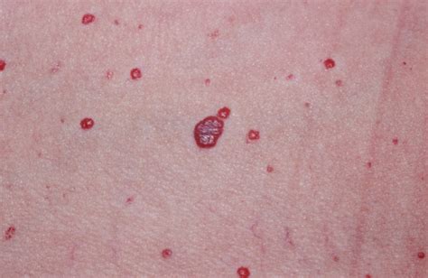 Hemangioma - Hemangioma Of Skin, Spine, Liver - Causes & Treatment