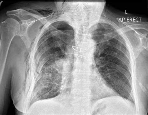 Pneumothorax | Chest X-Ray - MedSchool