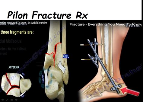 Tibial Pilon fracture Management — OrthopaedicPrinciples.com