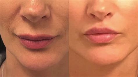 Lip Lift Procedure with Before and Afters - YouTube