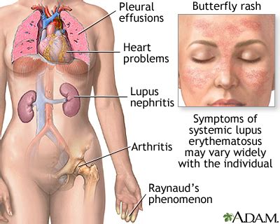 Systemic lupus erythematosus: MedlinePlus Medical Encyclopedia