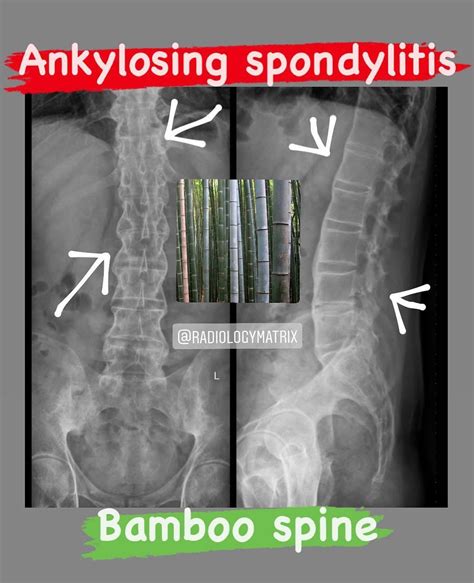 Ankylosing Spondylitis Bamboo Spine