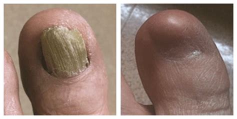 Surgical Removal of a Painful Toenail - Dr. Nicholas Campitelli