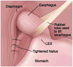 Hiatal Hernia Surgery Overview - Santa Monica, CA & Encino, CA