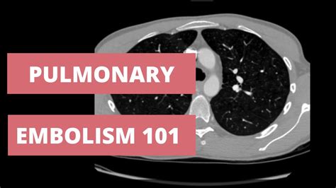 How to Identify a Pulmonary Embolism on CT - Search Pattern for CTA ...