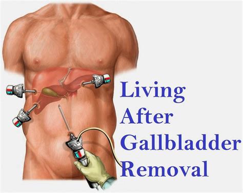 Living After Gallbladder Removal | Gallbladder, How to remove, Healthy ...