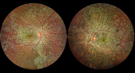 Multifocal Choroiditis - Retina Image Bank