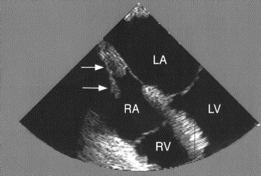 Echocardiography and excision of lipomatous hypertrophy of the interatrial septum - The Annals ...