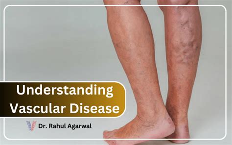 Understanding Vascular Disease: Causes, Symptoms, and Treatment Options