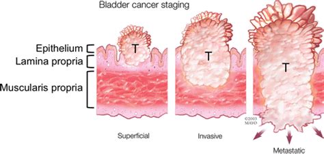 Complications of Intravesical BCG Immunotherapy for Bladder Cancer | RadioGraphics