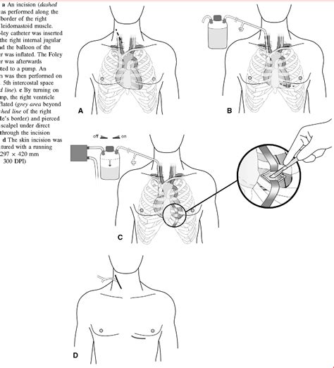 Clamshell Incision Versus Left Anterolateral Thoracotomy. Which One is Faster When Performing a ...