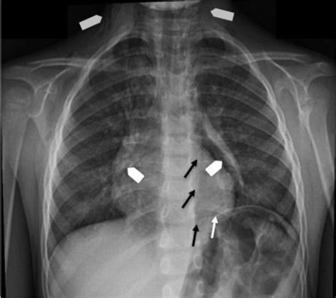 Subcutaneous Emphysema Neck