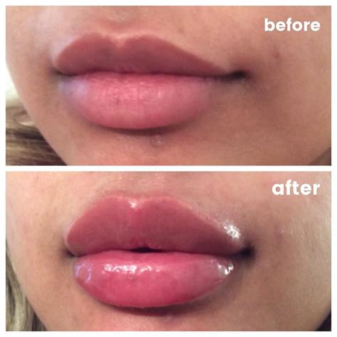 Pin by Bernice Lawlor on makeup | Lip injections, Lip fillers, Lip enhancement