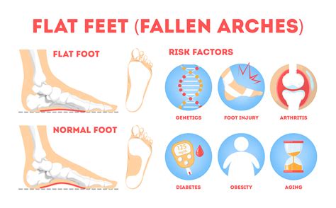 Common causes of painful feet: Flat Foot and Bunions – Healthsprings