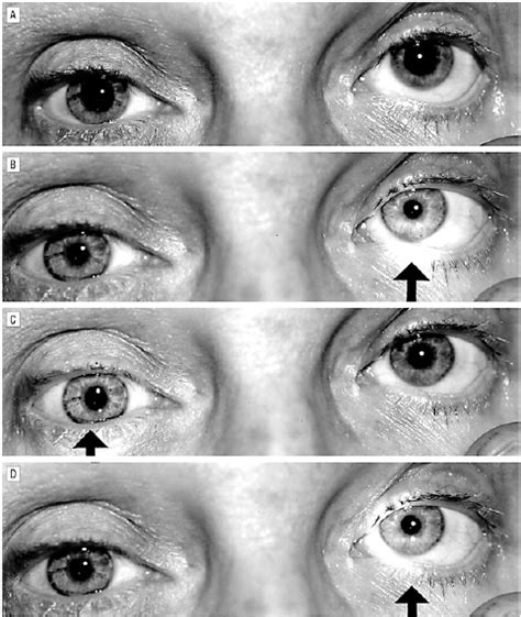 Relative Afferent Pupillary Defect (Marcus-Gunn Pupil) - MRCP PACES - LearnHaem | Haematology ...