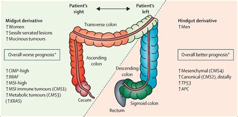 Colorectal cancer - The Lancet