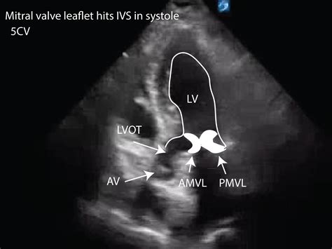 Systolic anterior motion SAM - Critical Care Sonography