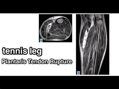 Leg Tendon Injury : Achilles tendon - Wikiwand / There are two tendons that run down the back of ...