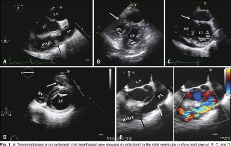 Figure 1 from Double Chambered Right Ventricle with Ventricular Septal Defect in Adults: Case ...