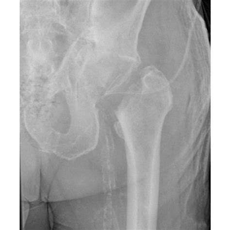 Postoperative anterior-posterior view after femoral neck osteotomy | Download Scientific Diagram