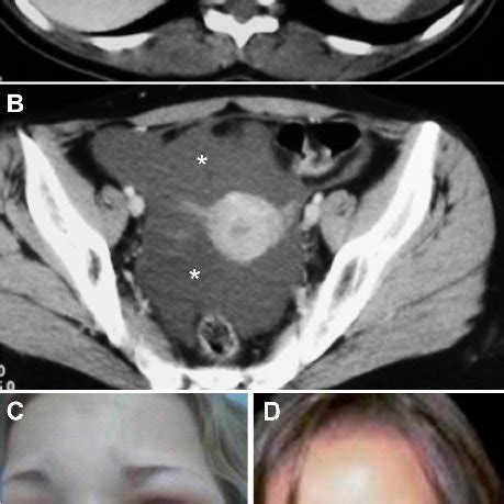 MRI of the pelvis showing effusion with soft tissue swelling and ...