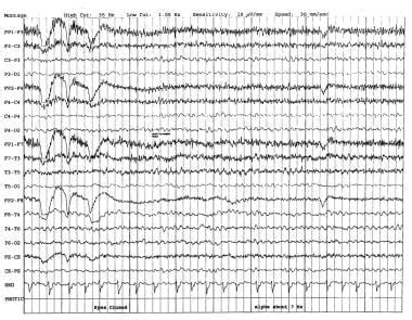 EEG in Dementia and Encephalopathy: Overview, Dementia, Vascular Dementia