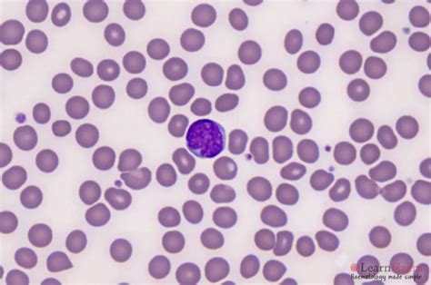 Mantle Cell Lymphoma - LearnHaem | Haematology Made Simple