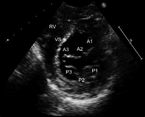 Parasternal Short Axis Mitral Valve