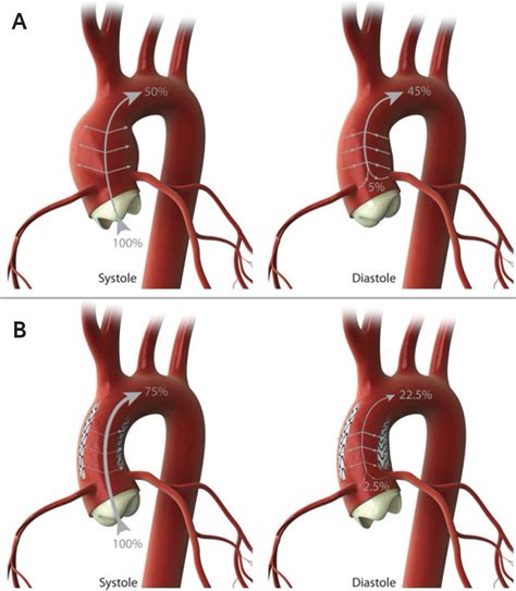 Complications and Failure Modes in the Proximal Thoracic Aorta - Endovascular Today