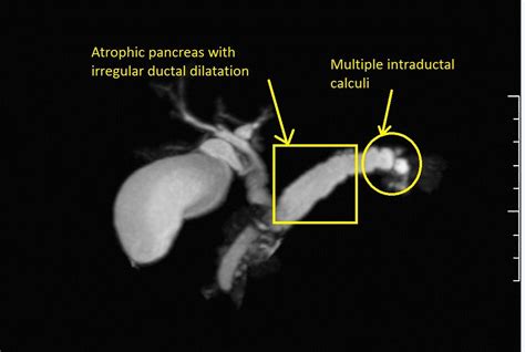 Chronic pancreatitis other imaging findings - wikidoc