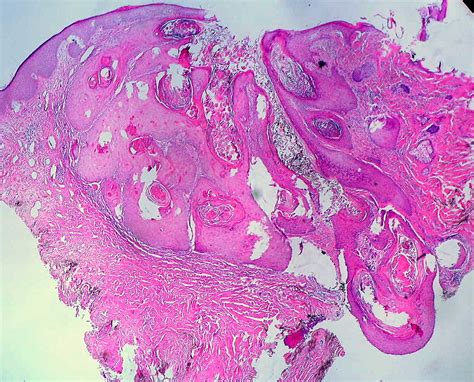 Keratoacanthoma Histology