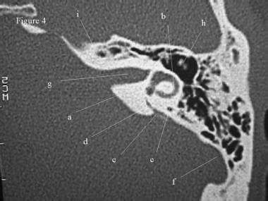 CT Scan of the Temporal Bone: Overview, Normal Anatomy of the Middle ...