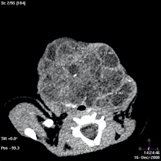 Teratoma | Obgyn Key