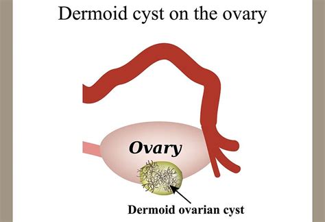 Dermoid Cyst - Types, Reasons, Signs & Treatment